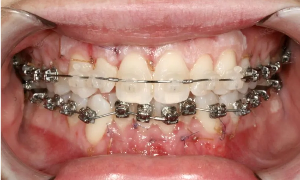 Clinical photo from Becca's surgically accelerated orthodontics case